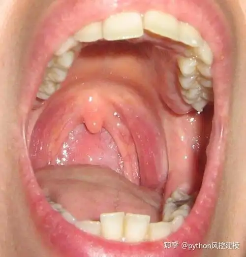 一图读懂慢性咽喉炎chronicpharyngitis