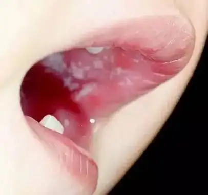 疱疹性咽峡炎又到高发期别与手足口病口腔溃疡搞混了