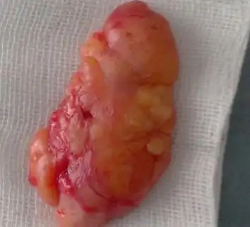 乳腺脂肪瘤主要的危害是什