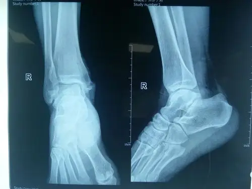 这是今天收入院患者右脚骨折的dr