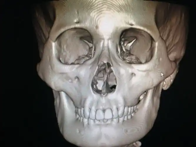 一例鼻骨骨折闭合性复位手术分享