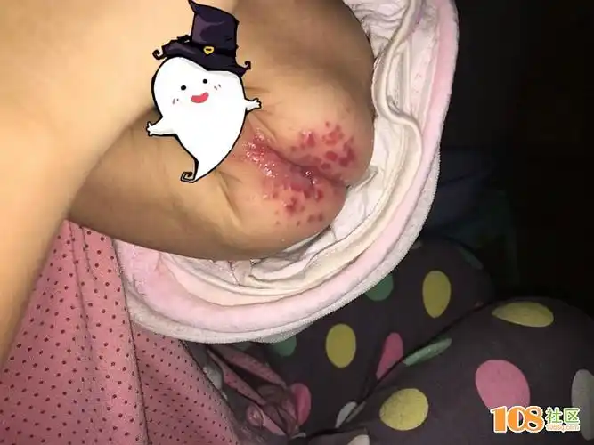 求助社友:宝宝屁股一片红色疹子,哭闹不停这是怎么了