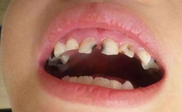 父母不要扔,医生告诫:关键时刻能救孩子一命|龋齿|拔牙|牙齿_网易订阅