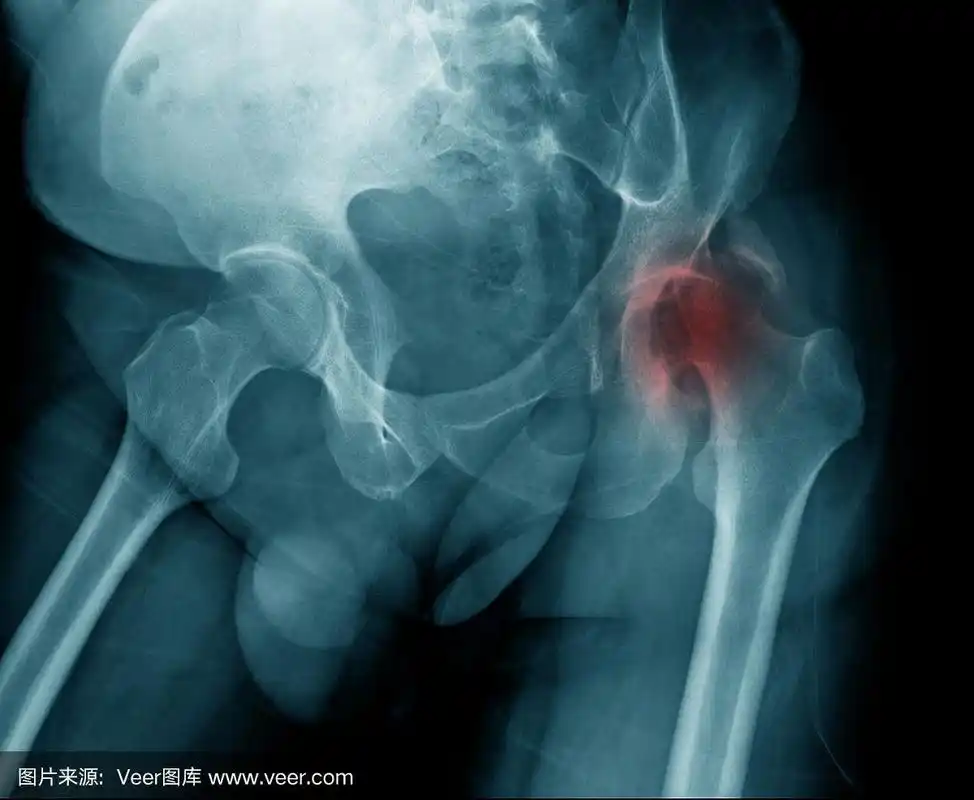 老年妇女x线照片显示髋关节退行性改变,右侧髋关节缺血性坏死