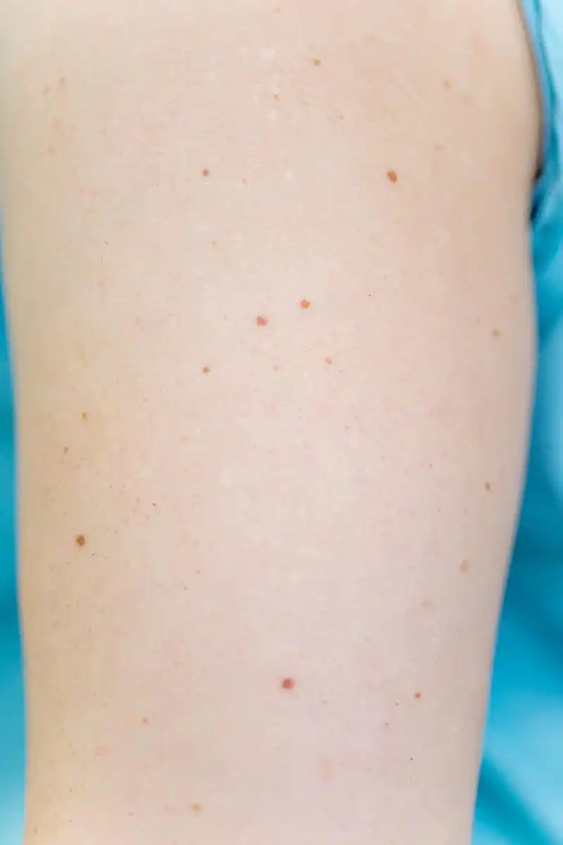 如果您身上有红色的小红点痣,这可能是以下几种情况之一: 一,血管瘤