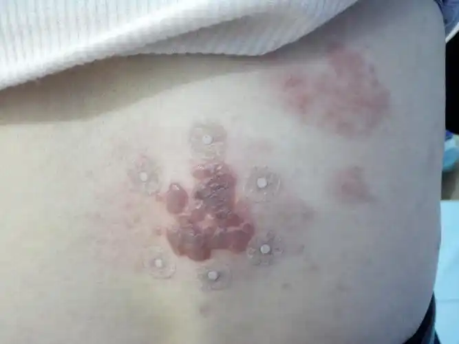 聊聊疼痛病带状疱疹