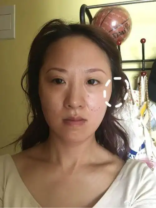 线雕后遗症变得很老线雕越做越老全脸线雕淤青变黄几天能好