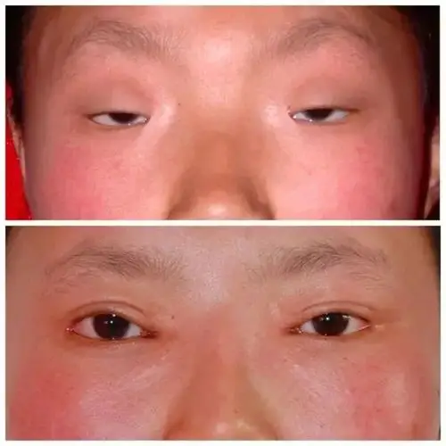 重度内眦赘皮 重度轮匝肌肥厚小眼开大术术前术后对比图吉林大学第一