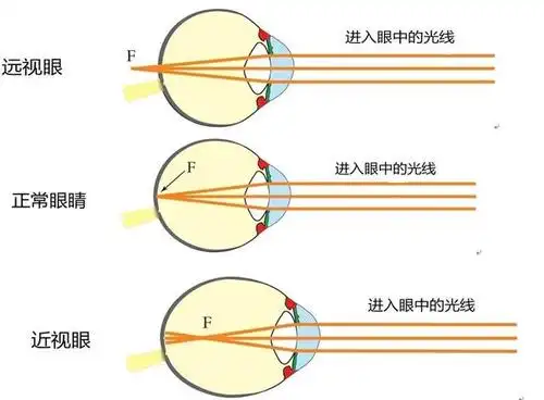 孩子的远视储备不足,是不是马上就要近视了?