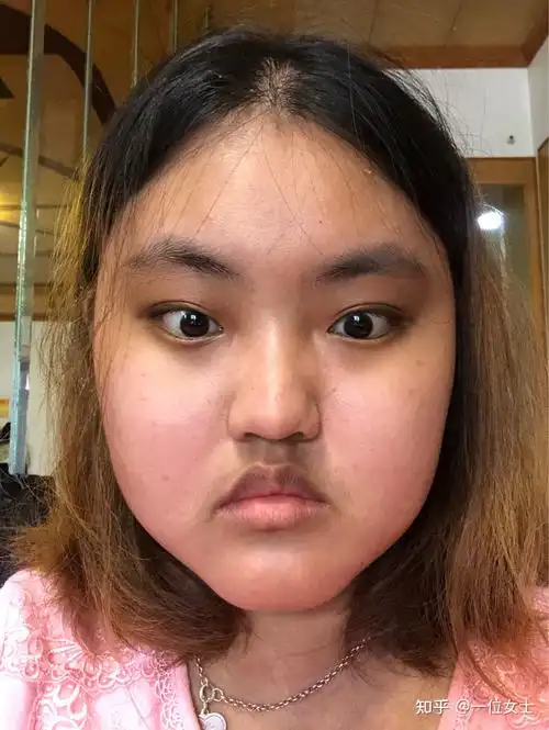 记录吃激素满月脸的恢复状况