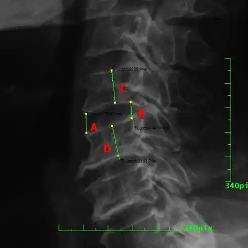 27颈椎x线诊断》拾遗