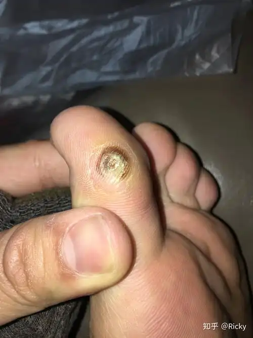 刚长出来的小跖疣怎么治?