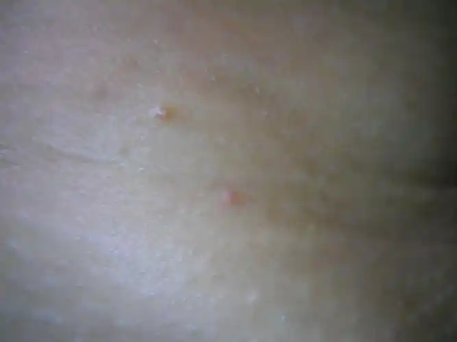 脖子上长了几个如图的小疙瘩,自己拍的.偶尔有些痒.