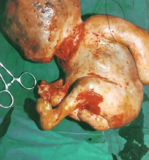 究其原因,专家解释:胎死腹中后,会被人体将死婴视为异物加以排斥,有时