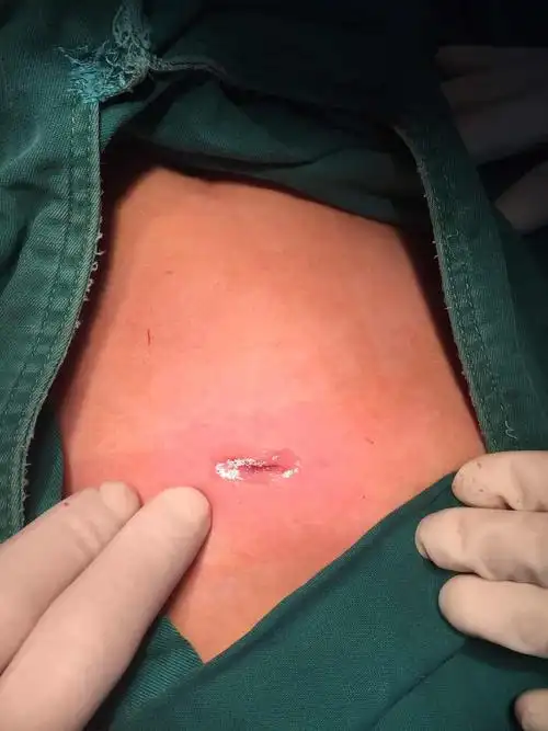 对于14岁以上的未成年人,此时的疝气多合并有明显的腹横筋膜缺损,手术