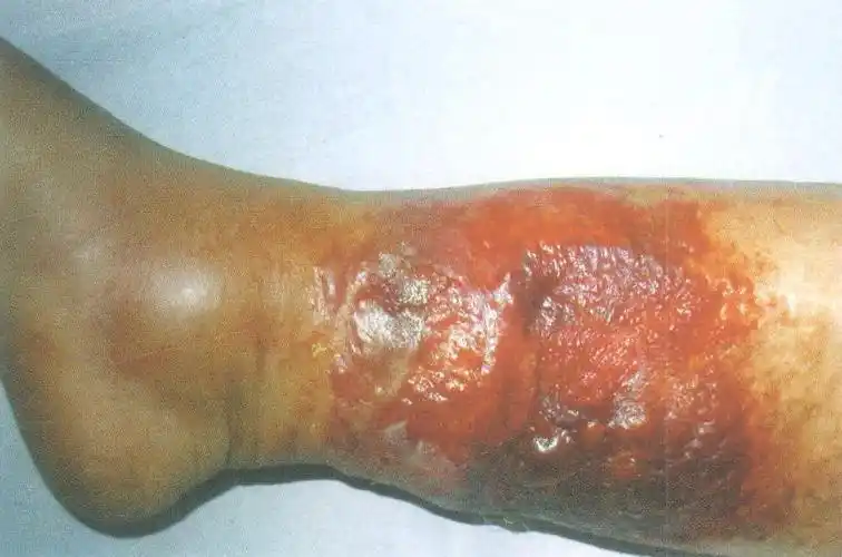 (图) 烧伤后皮肤细菌感染 "丹毒" 样表现