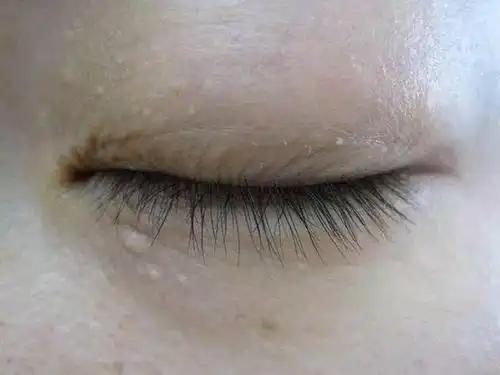 眼部长出脂肪粒跟这个护肤品有关