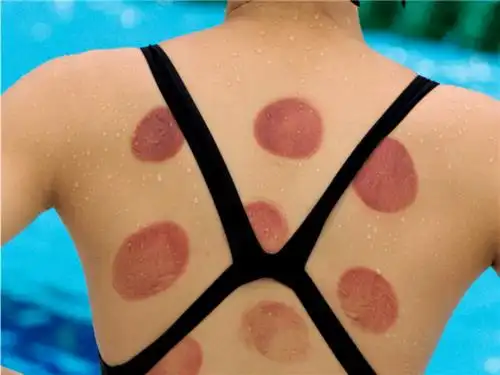 菲尔普斯背上红圈,是中医拔罐的神奇还是安慰剂效应