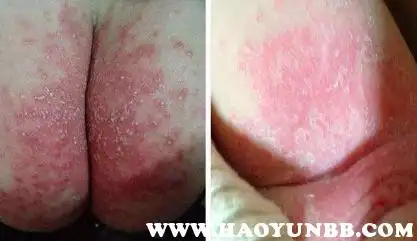 这个时候宝妈们如果发现宝宝出现了尿不湿的轻微症状之后要及时护理