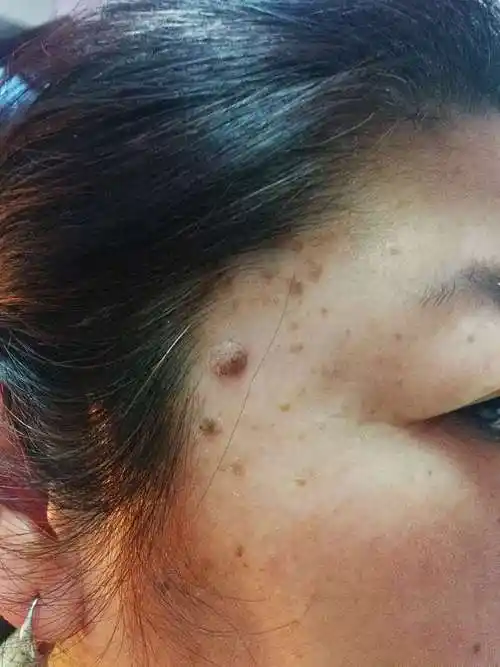 患者女52岁160身高75公斤一年前脸颊两侧出现褐色斑块