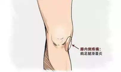 鹅足腱滑囊炎的康复治疗