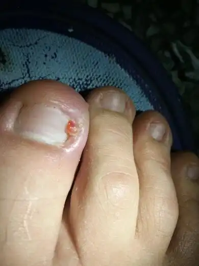 这个甲沟炎,自己不想去把指甲,有什么比较好的治疗办法.