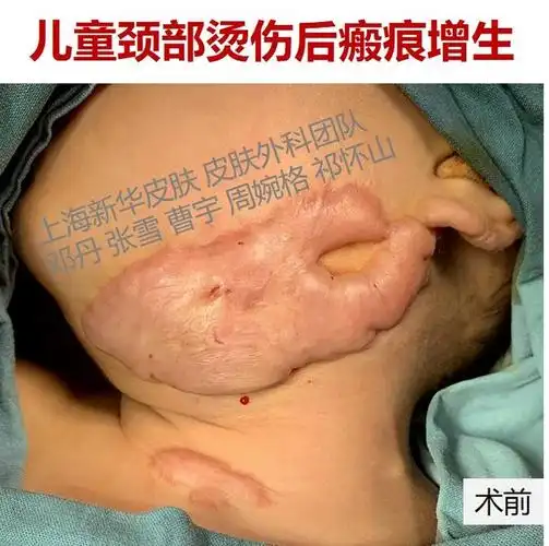案例系列27不想埋扩张器也不想植皮颈部大疤痕怎么治