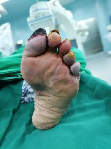 三医院血管外科成功救治一个90岁的下肢部分坏死患者