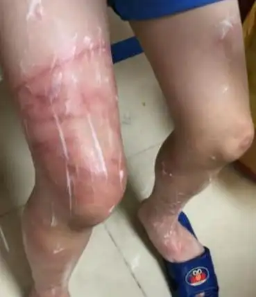 男孩海边游玩遭水母蜇伤植皮保腿!这个错误操作,千万别再犯