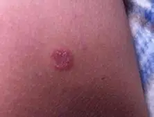 硬下疳怎么治疗/治疗方法_硬下疳早期症状表现_硬下疳是怎么引起的-复