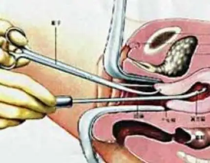 刮宫后多久可以要孩子