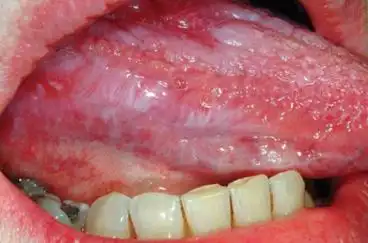 口腔扁平苔藓 - 求真百科