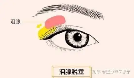 双侧泪腺脱垂是上睑下垂还是肿泡眼