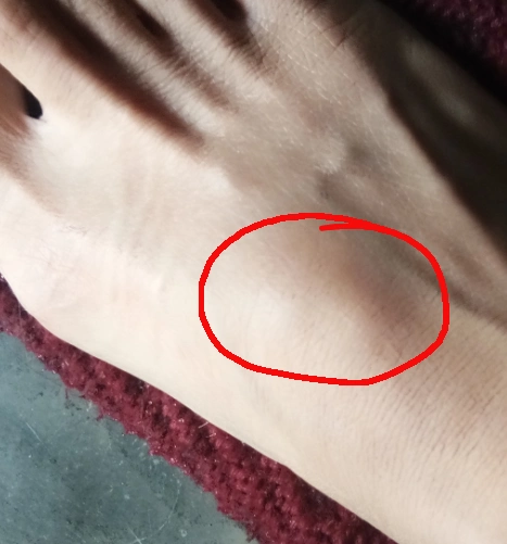 脚背上鼓了一个包走路用力都很痛怎么回事呀