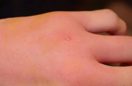 貌似被蜘蛛咬了 红肿一大片 有图