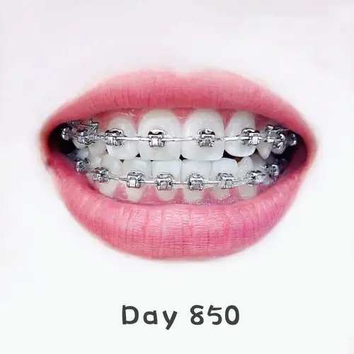 钢牙矫正牙齿的图片