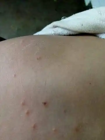 孩子背上起了好多疙瘩,是怎麼回事?