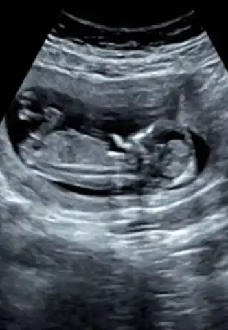 请问这十三周能看出来男孩女孩吗