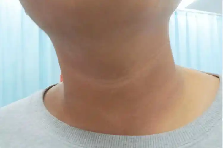 提醒:脖子出现3个异常,可能是癌症在靠近