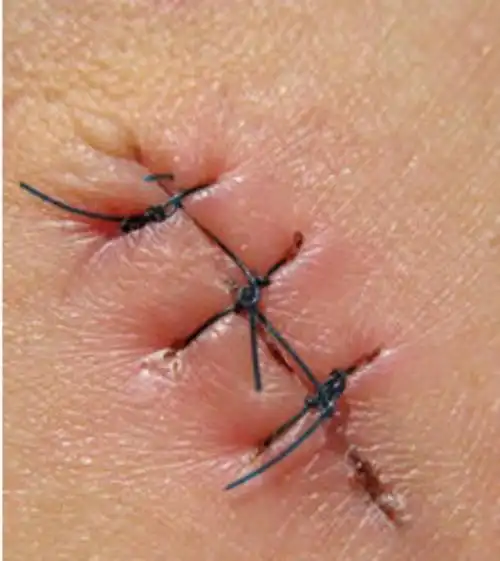 宝宝摔伤该不该缝针