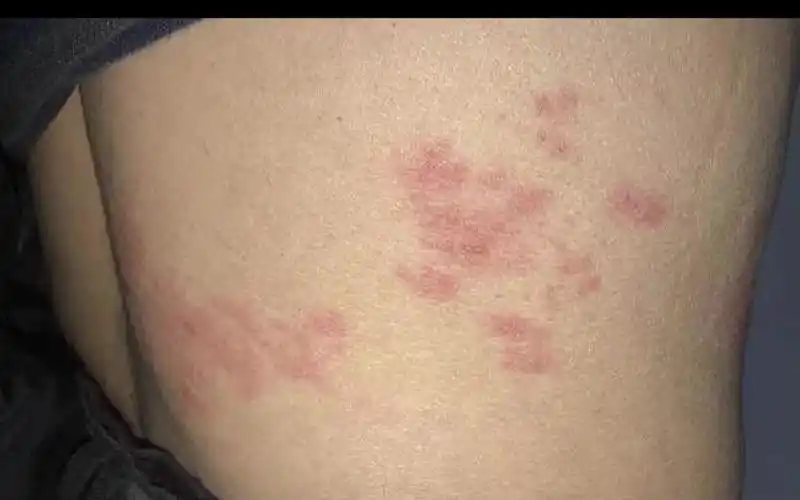 no97:腰部长一串水泡很疼 四步教你解决