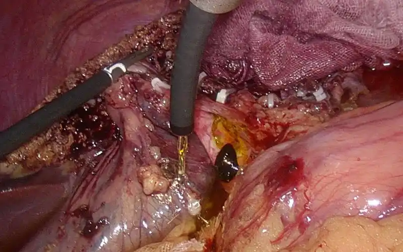 千枚胆囊结石的腹腔镜胆囊切除术1例