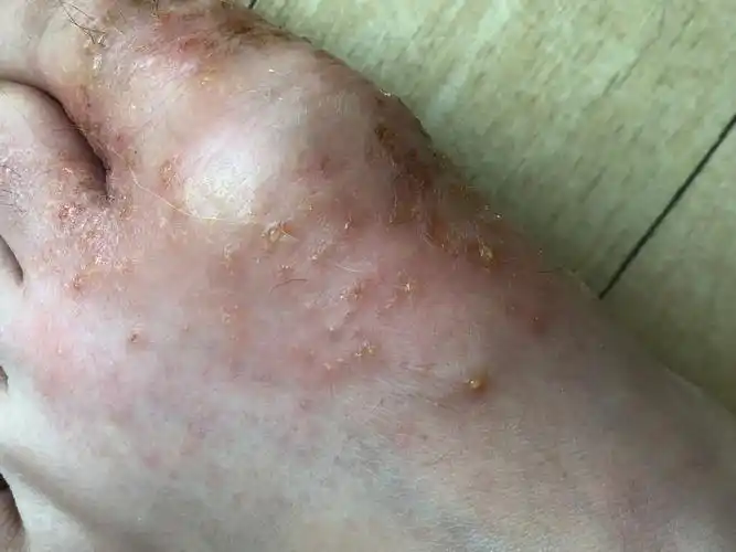 年龄:28岁女详情:去年夏天开始脚上气疱疹,一直不好.