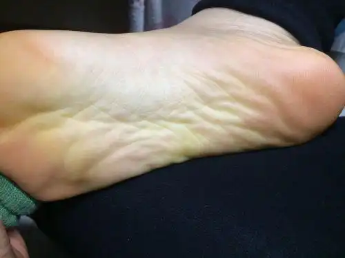 血流的方向相对较远,毒素很容易沉积在那里,脚底的纹路可能会增加