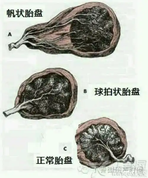 球拍状胎盘 帆状胎盘