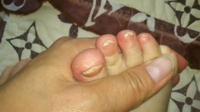 问:宝宝两岁,两月前出现大脚趾如图情况,现在孩子八个脚趾都如下图.