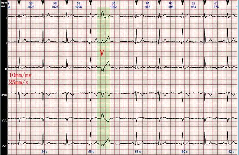 心电图病例分析右束支型室性早搏
