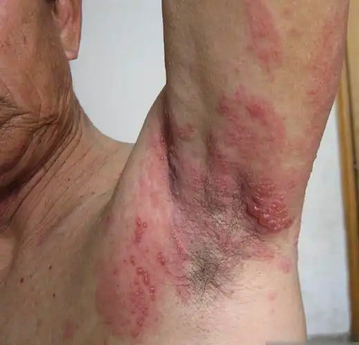 艾滋病皮肤症状 (5)