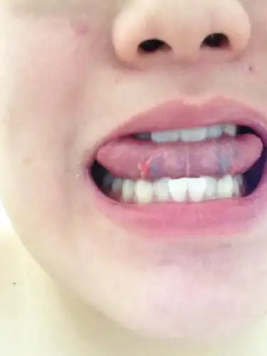 舌头下面有不明物体.像是上火.怎么办