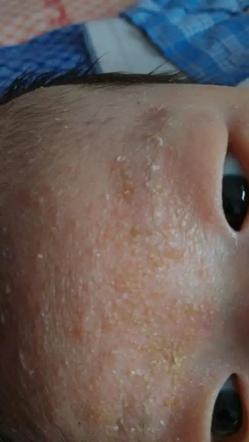 宝妈们,帮忙看看宝宝额头上厚厚的一层像污垢一样的究竟是什么?